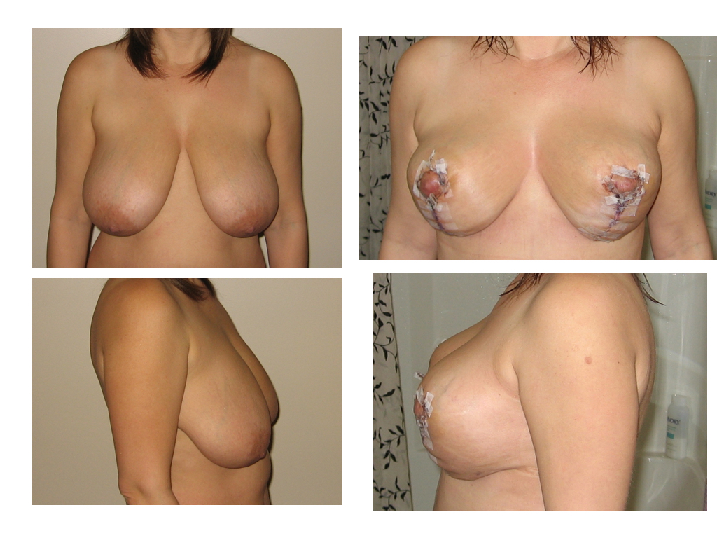 BREAST LIFT